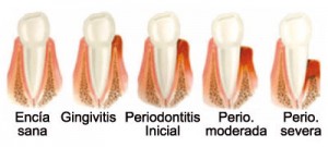 Periodoncia dental en Santomera