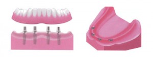 Implante dental en clínica Santomera