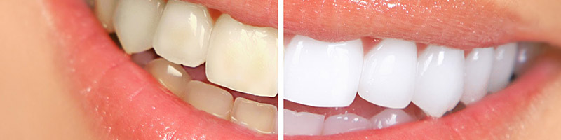 El blanqueamiento dental únicamente puede realizarse en la clínica dental