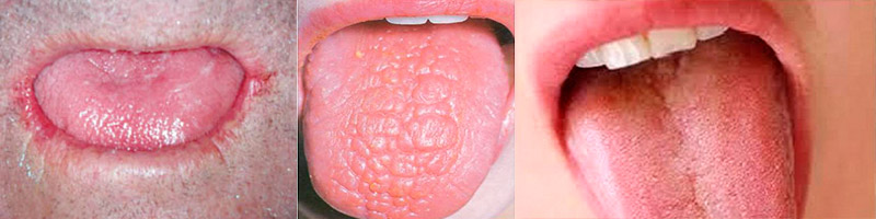 Síndrome de boca seca o xerostomía