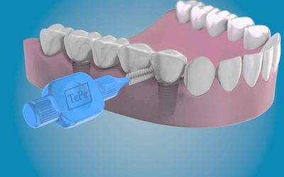 Por qué pueden fallar los implantes dentales